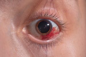Eye injury claim 