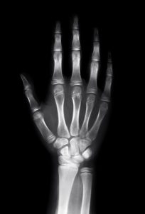 hand injury claim