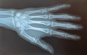 finger injury compensation amounts