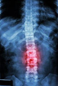 An X-ray highlight a spinal injury in red.