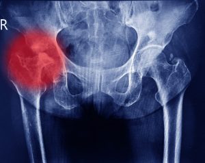 You could make a hip injury compensation claim for an accident at work. 