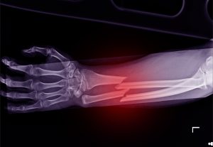 An x-ray showing a broken arm. 